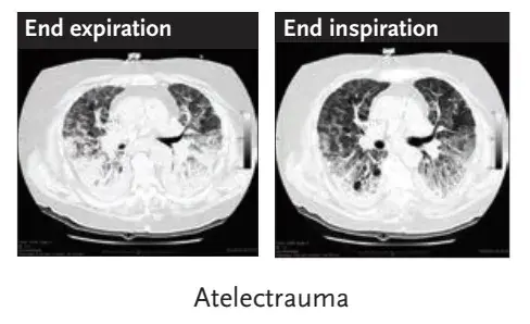 肺保护不得不了解的呼吸力学知识：说说如何吹爆一个气球(图4)