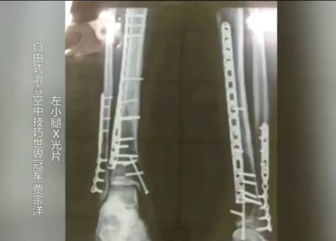 这张X光片刷屏！网友：破大防了......(图1)